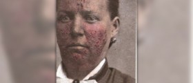 Everything you need to know about acne rosacea