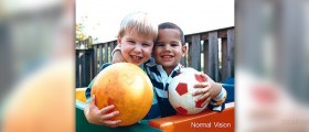 Eye disease - Amblyopia