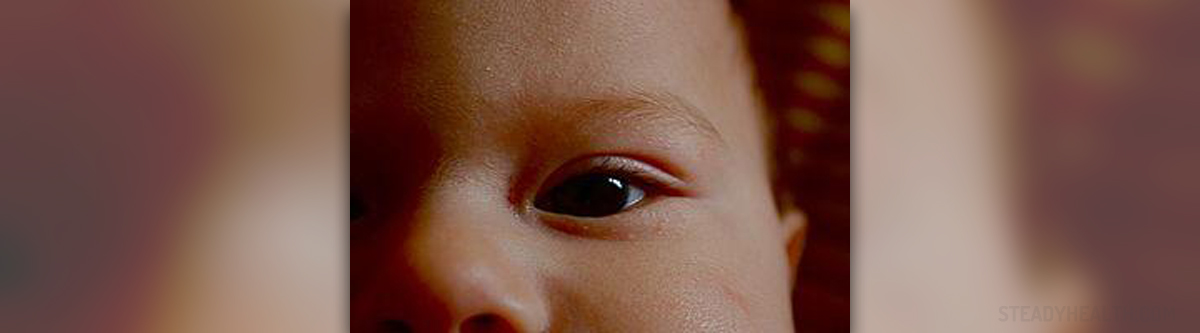 eye-infections-in-babies-children-s-teens-health-articles-family