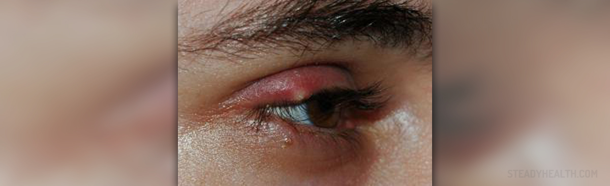 what causes eye styes