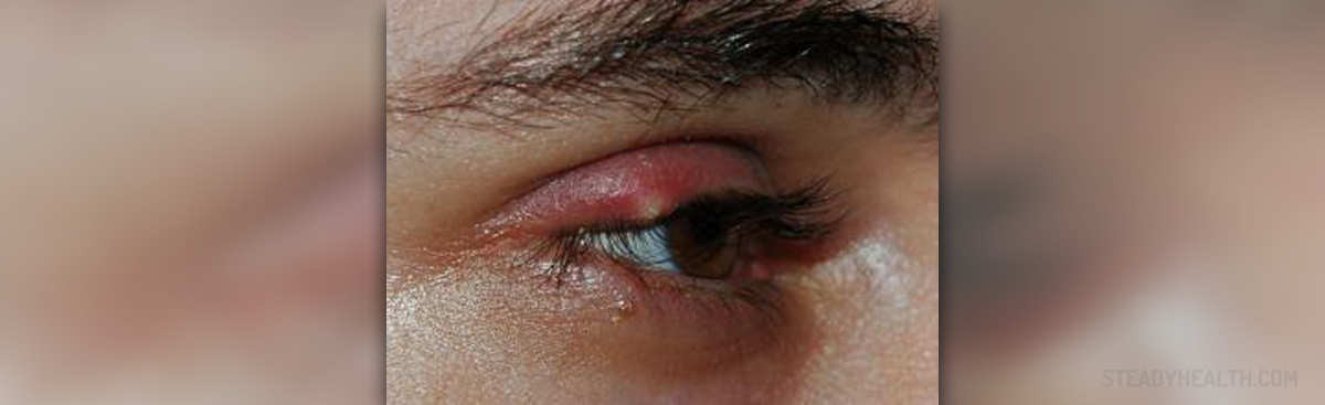 Eye Stye Symptoms And Causes Eye Disorders And Diseases Articles 
