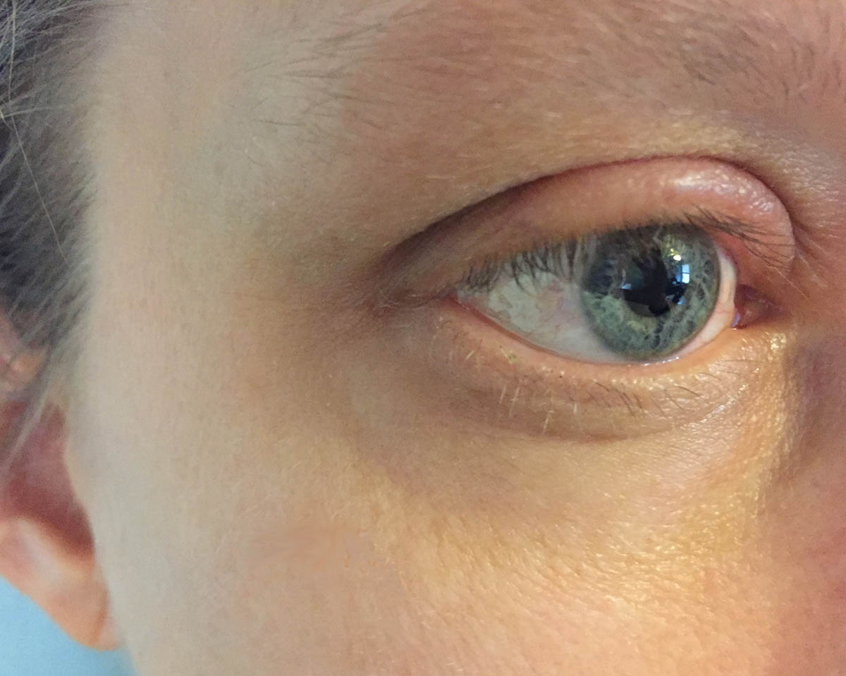 Medical Term For Lower Eyelid Swelling at Viola Dawson blog