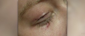 Eyelid surgery after-care