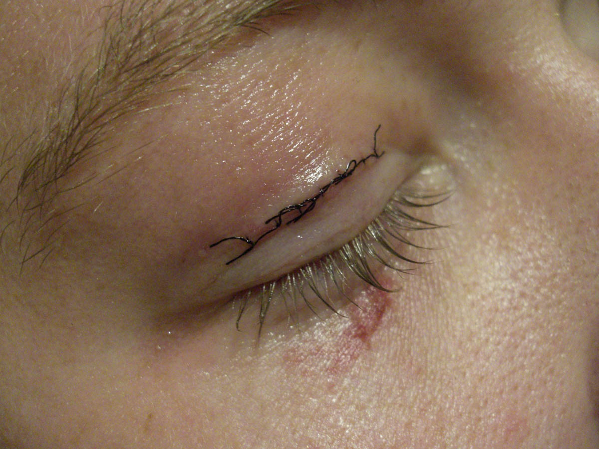 Left Eyelid Itch Meaning