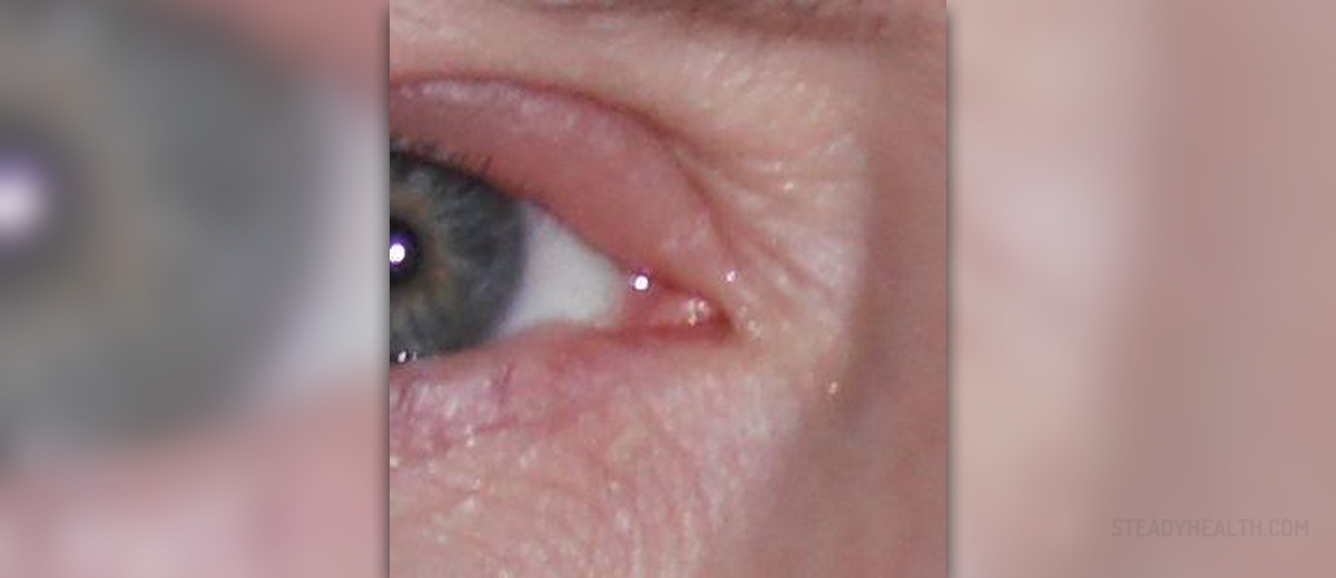 Eyes Infections Blocked Tear Duct Eye Disorders And Diseases