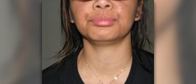 Facial exercises: Do they work