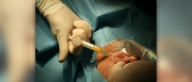 Facial liposculpture facts