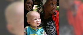 Facts about albinism