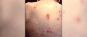 Facts about varicella zoster virus