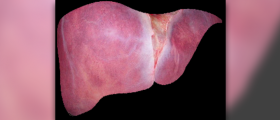 Fatty liver disease