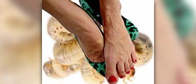 Varicose veins in pregnancy - are there any cures?