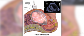 Fetal distress - what now?
