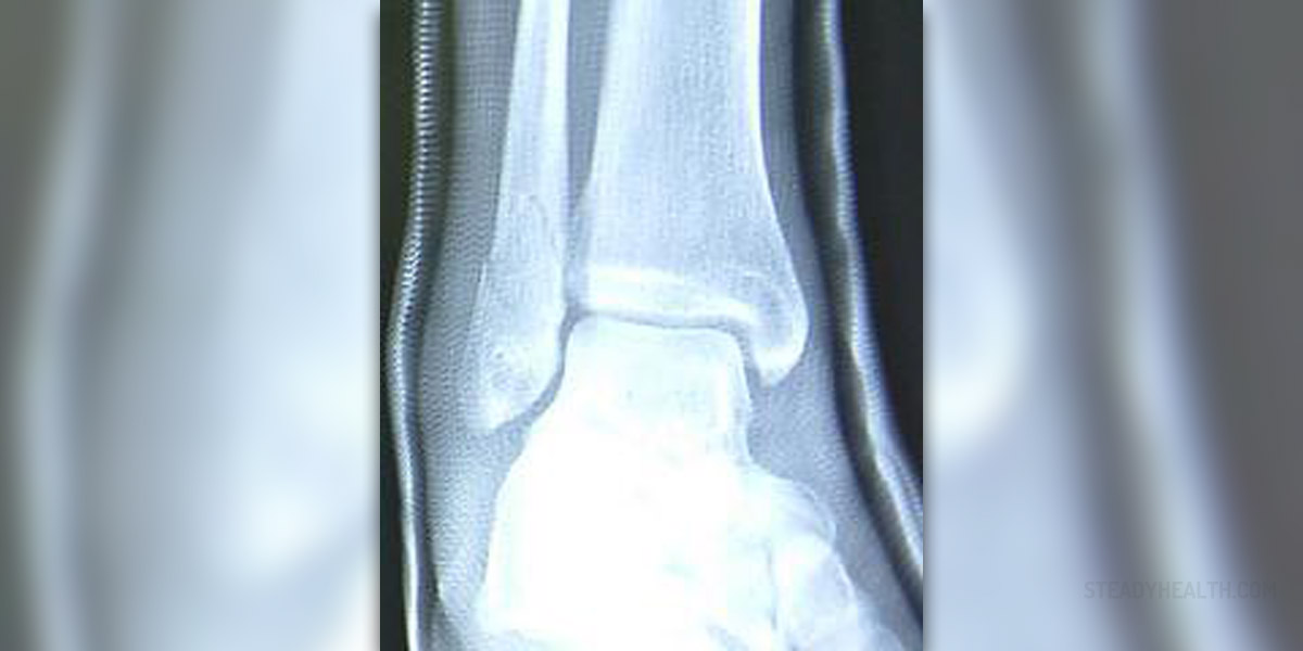 spiral fracture distal fibula