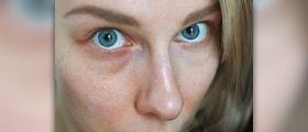Fine lines under eyes