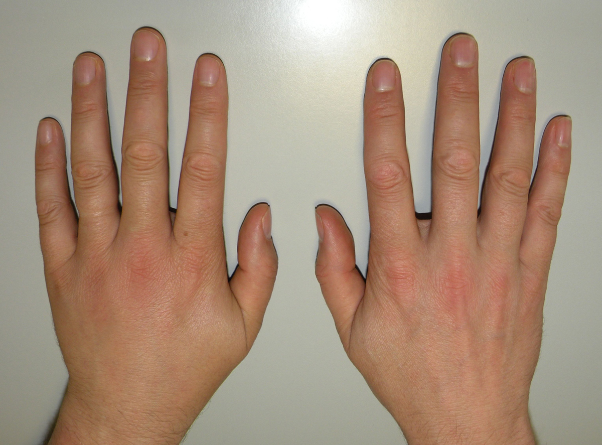 sprained-finger-facts-general-center-steadyhealth