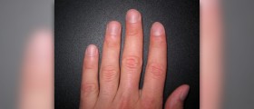 Fingernail fungal infections