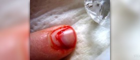 Fingernail infection
