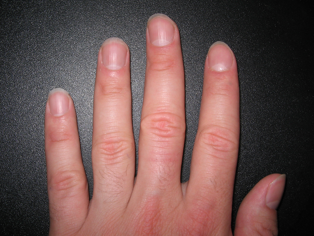 What Causes Fingernail Beds To Turn Blue at Jay Kersh blog