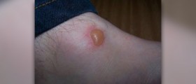 First aid burn treatment