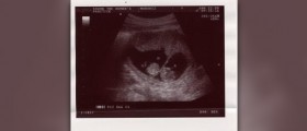 First signs of twin pregnancy