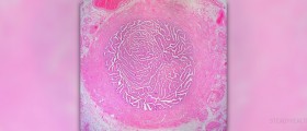 Fixing blocked fallopian tubes