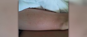Flea bites on children