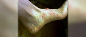 Fleas on humans treatment