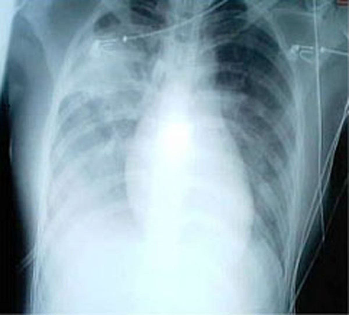 Fluid in lungs caused by pneumonia | Respiratory tract disorders and