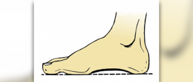 Foot drop brace types
