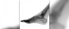 Foot tingling facts