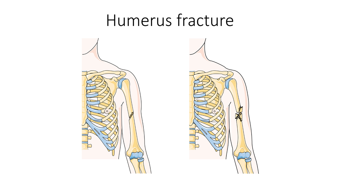 Fractured humerus treatment | General center | SteadyHealth.com