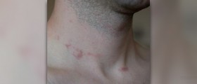 Front neck pain
