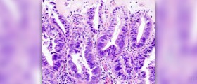 Gallbladder cancer symptoms