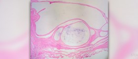 Ganglion cyst overview