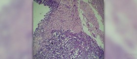 Gastric bypass surgery: cost effective or just costly ?