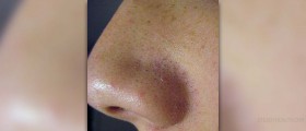 Get rid of blackheads