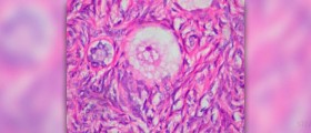 Get the facts on the signs of ovarian cysts