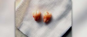 Getting wisdom teeth pulled