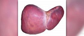 Gilbert's syndrome facts