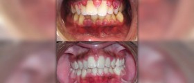 Gingivitis treatment options