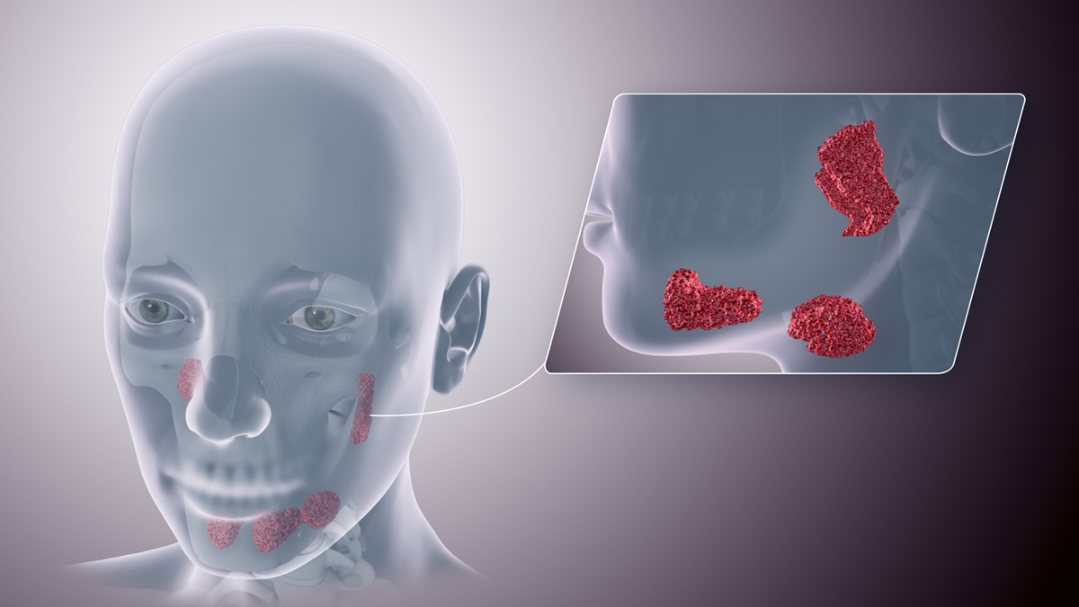 Painful Salivary Glands General Center