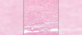 Goals of Shwachman-Diamond syndrome (SDS) treatment