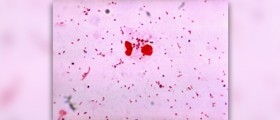 Gonorrhea symptoms