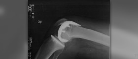 Gout home treatment