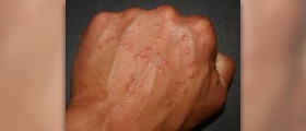 Granuloma annulare treatment