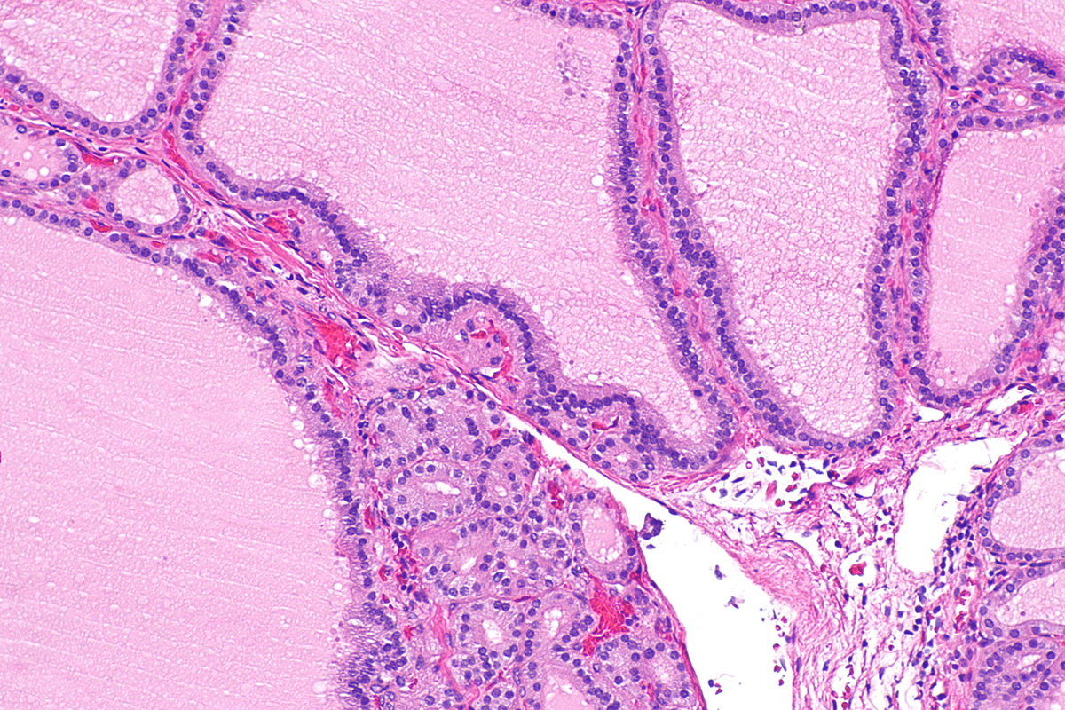 graves-disease-picture-image-on-medicinenet