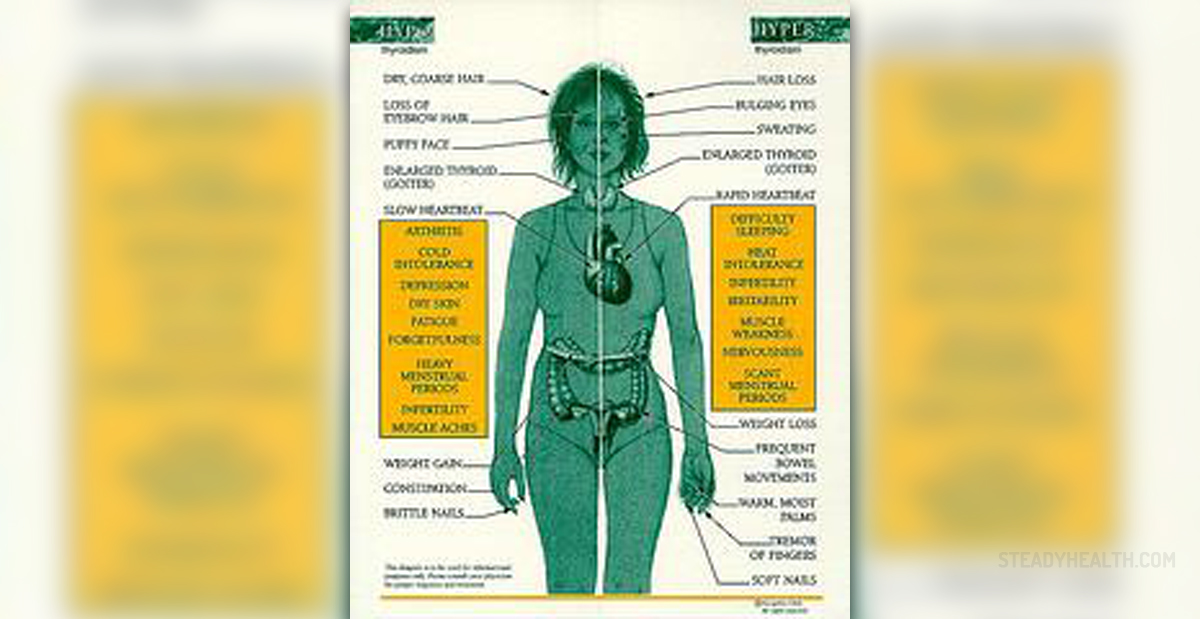 Graves' disease - Overactivity of thyroid hormone production