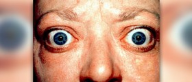 Graves' disease symptoms