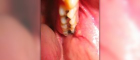 Gum disease and infection