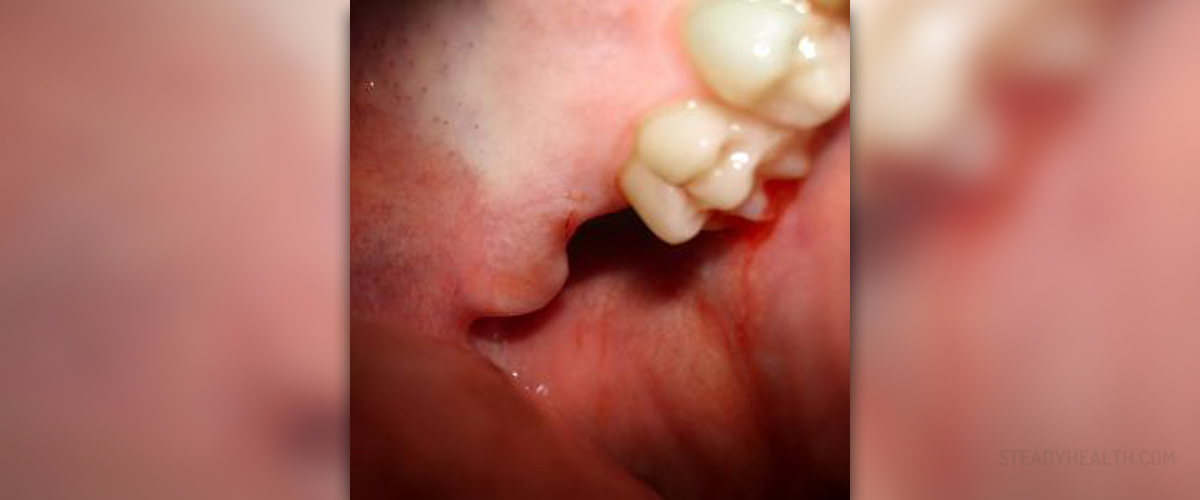 gum-infection-after-tooth-extraction-ear-nose-throat-and-dental